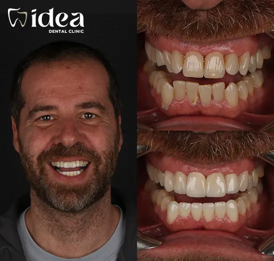 Before & After 12