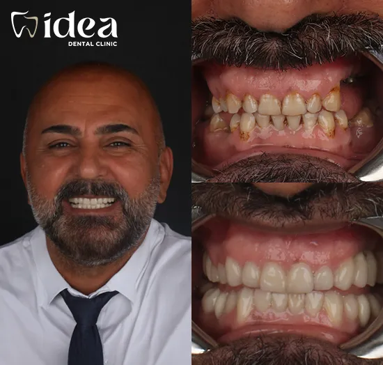 Before & After 2