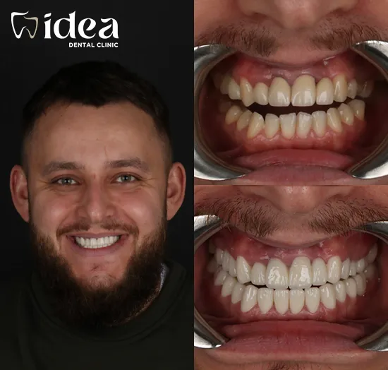 Before & After 4