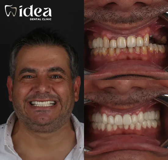 Before & After 6